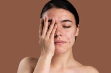 Wajah Berjerawat Jadi Tanda Lebih Awet Muda, Mitos atau Fakta?